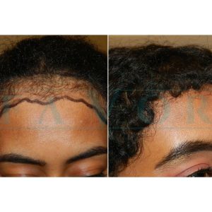 Hair Transplant Medical Tourism