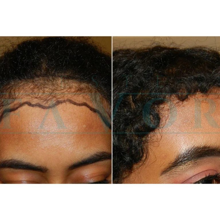Hair Transplant Medical Tourism