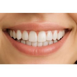 Perth Dentist Teeth Whitening
