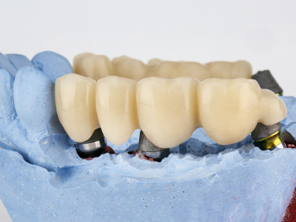Tooth Replacement Dental Bridges